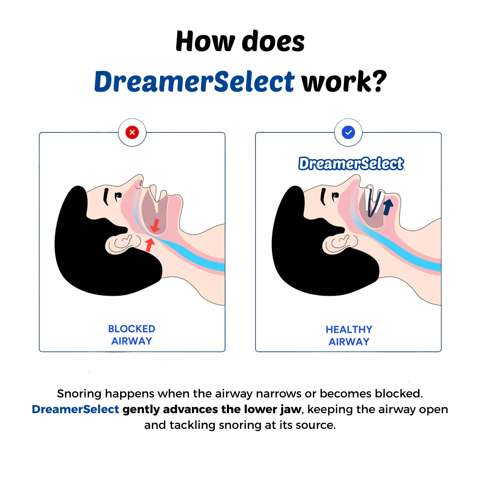 DreamerSelect® Anti-Snoring Mouthpiece